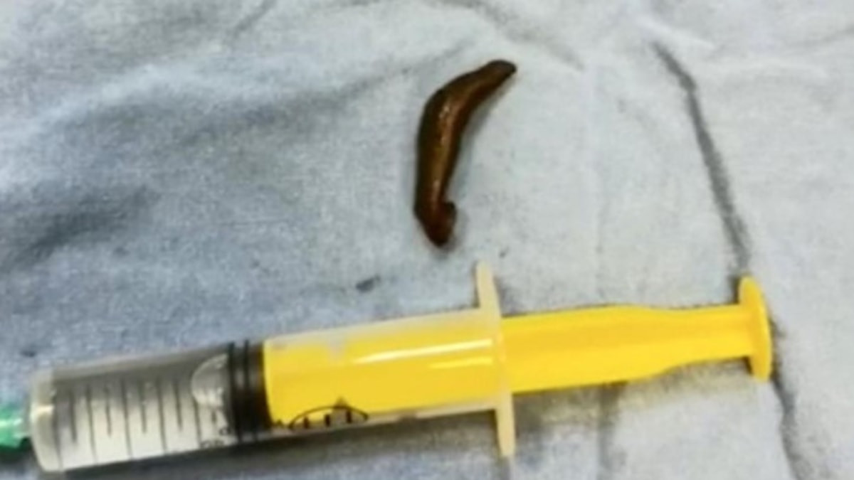 Çorum'da şiddetli boğaz ağrısının nedeni sülük çıktı