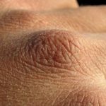 Balık pulu hastalığı nedir