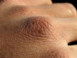 Balık pulu hastalığı nedir