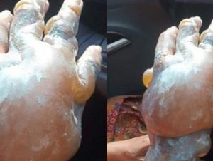 Diş macunu yanıklara iyi gelmiyor