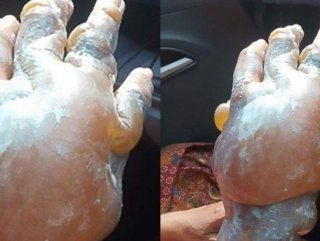 Diş macunu yanıklara iyi gelmiyor