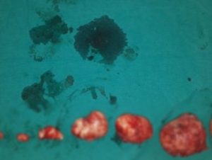 Hamile kalamıyorum diyen kadının rahminden ur çıktı