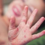 Kızamık vakaları dünya çapında dört kat arttı