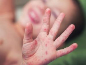 Kızamık vakaları dünya çapında dört kat arttı