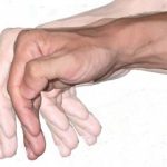 Parkinson hastalığı nedir