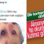 Tabipler Birliği hacamata karşı