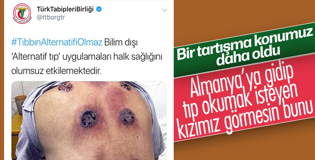 Tabipler Birliği hacamata karşı