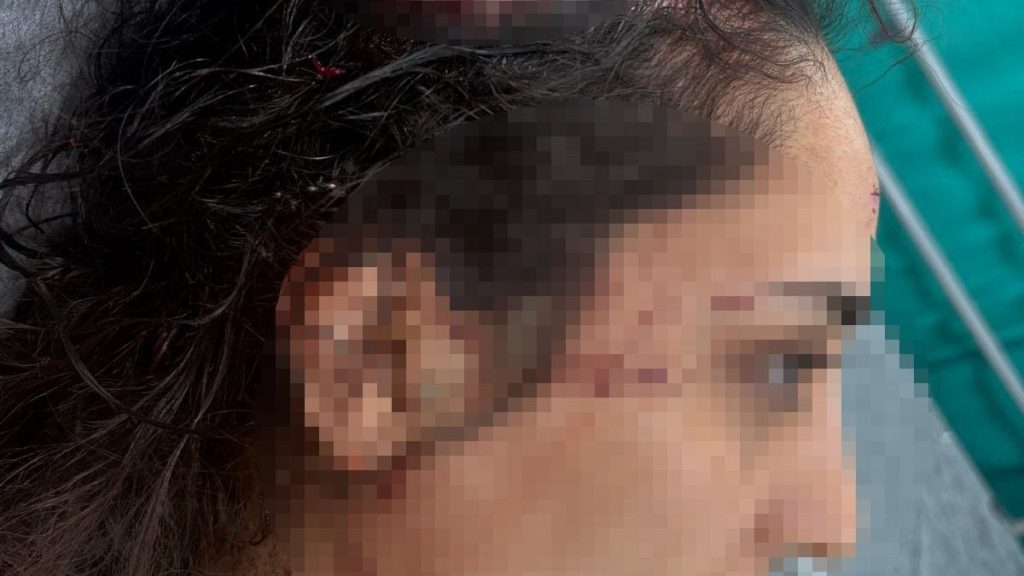 Adana’da bir kadın daha sokak köpeklerinin hedefi oldu