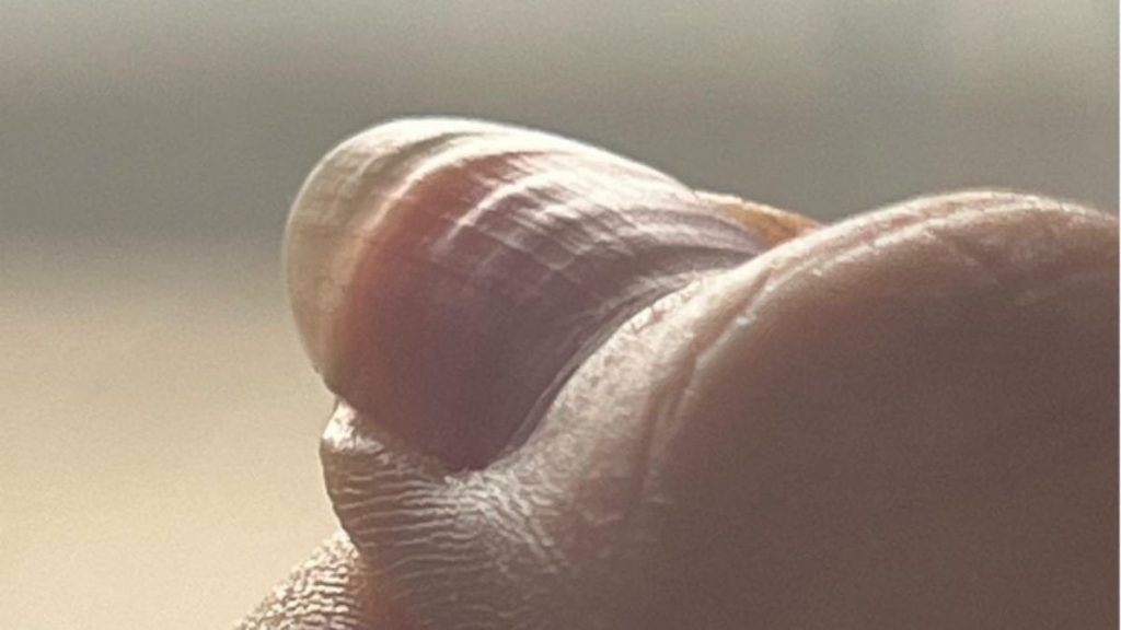 Dalgalı tırnak bakın neyin habercisi! Vücut böyle alarm veriyor…