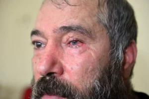 Dolmuş Şoförünün Gözünü Kaybetmesi