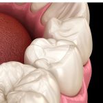 Estetik Dolguların Ömrünü Alışkanlıklarımız Belirliyor