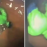 Hindistan’da çocuğun midesinden “hulk” çıktı