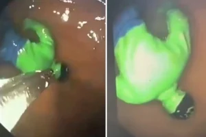 Hindistan’da çocuğun midesinden “hulk” çıktı