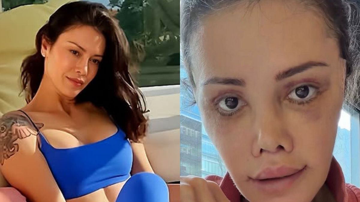 Yüz nakli yaptıran Didem Ceran’ın son hali: Harika gözüküyorum